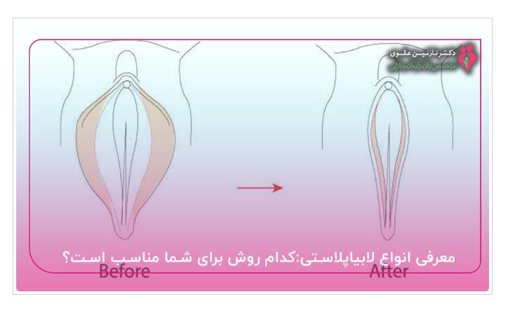 همه چیز درباره لابیاپلاستی: از چیستی تا انواع لابیاپلاستی و معرفی بهترین دکتر لابیاپلاستی در تهران