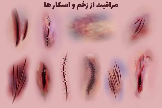 مراقبت صحیح از زخم ها: چگونه مانع ایجاد اسکار شویم؟