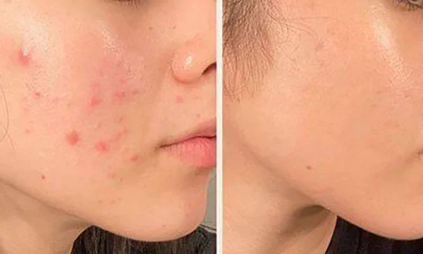  راهکارهای طبیعی برای درمان جوش و آکنه
