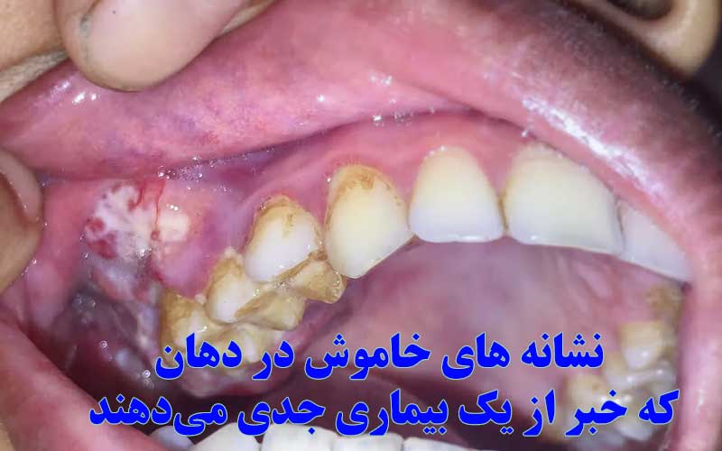 نشانه های خاموش در دهان که خبر از یک بیماری جدی می دهند  