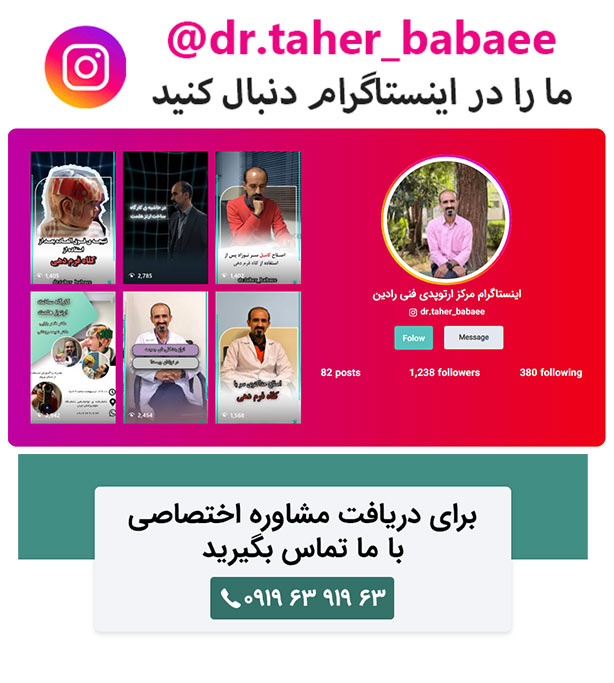 درمان دفورمگی سر نوزاد با کلاه فرم دهی