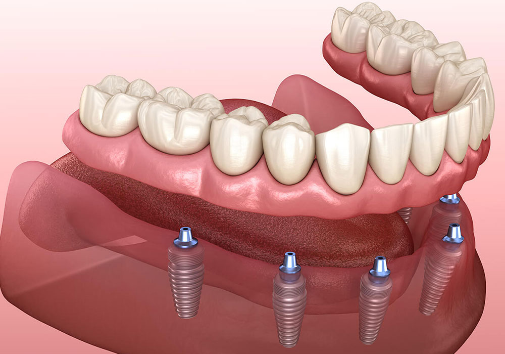 کجا ایمپلنت دندان انجام دهیم؟ بهترین کلینیک‌های ایمپلنت در قم