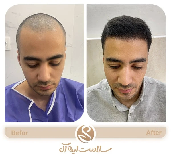 حداقل و حداکثر سن کاشت مو | بهترین زمان برای کاشت مو
